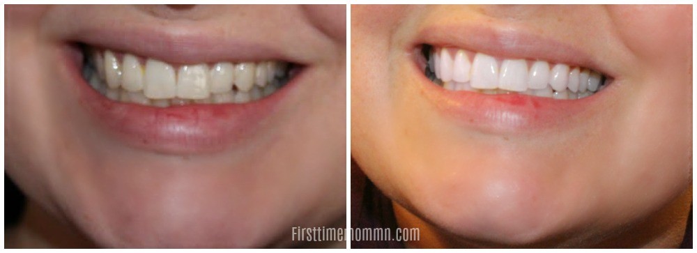 Smile Brilliant Teeth Whitening