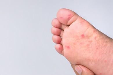 red rash on child's foot, hand foot mouth